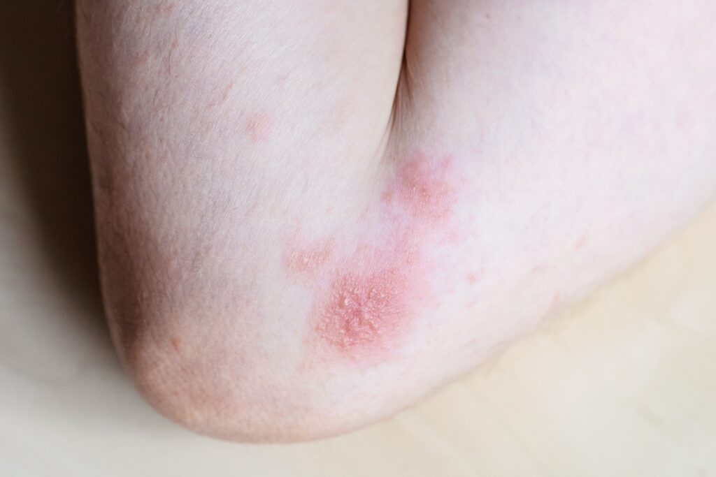 blisters-on-iinner-bend-of-the-elbow-close-up-min