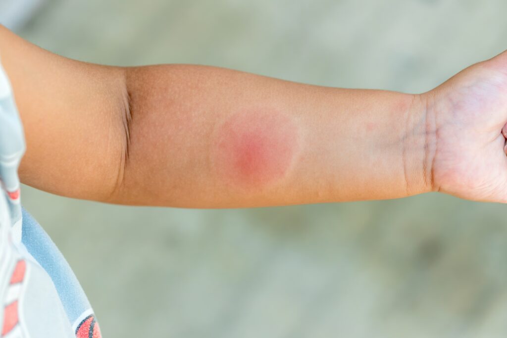 the-child-bit-a-mosquito-in-the-arm-itches-redne-min