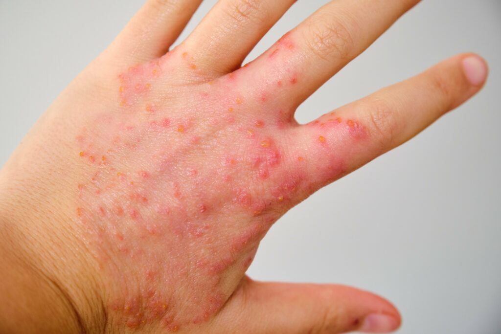 close-up-of-a-hand-with-eczema-atopic-dermatitis-min