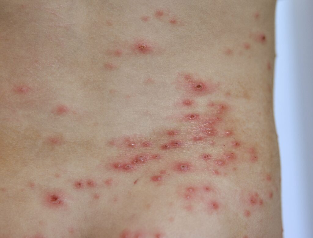 closeup-of-chicken-pox-rash-viral-infections-dis-min