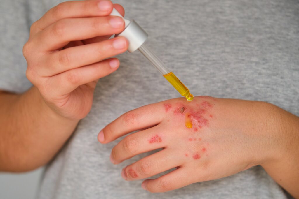 patient-hands-applying-rosehip-oil-on-eczema-min