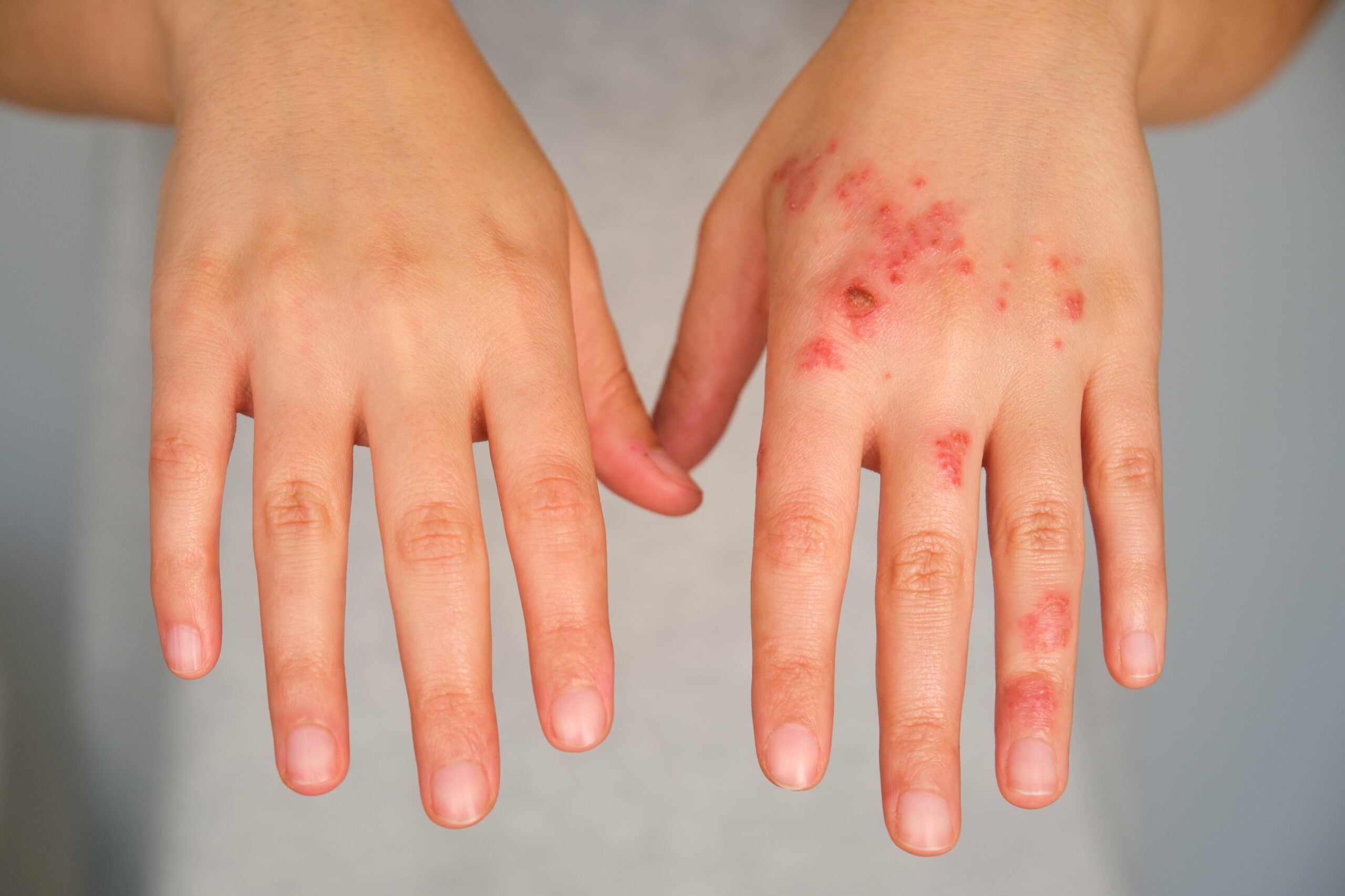 patient-hands-with-and-without-eczema-comparison-min