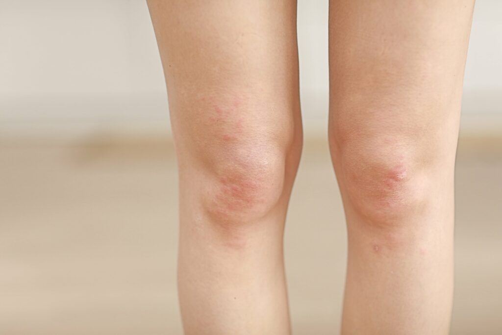 skin-allergies-legs-skin-women-closeup-of-red-pu-min