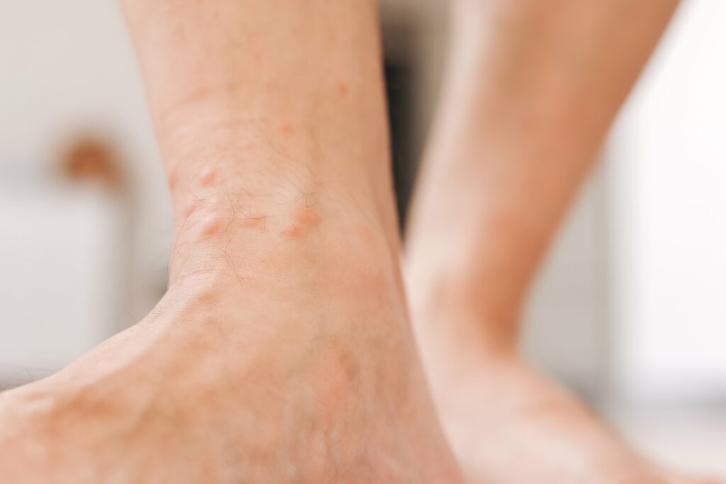 close-up-allergic-rash-dermatitis-eczema-on-man-fo-utc-min