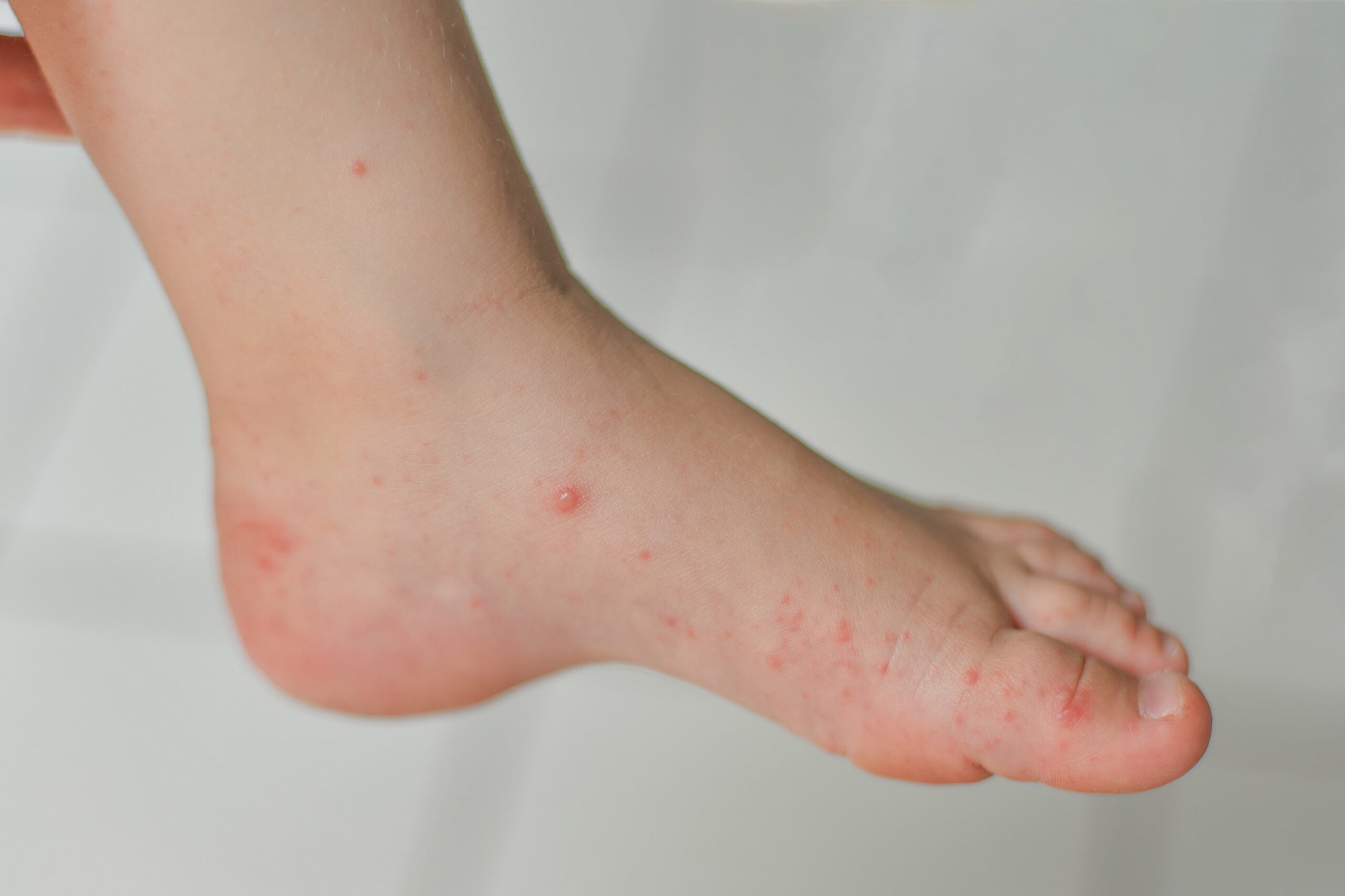 enterovirus leg arm mouth rash on the body of a ch