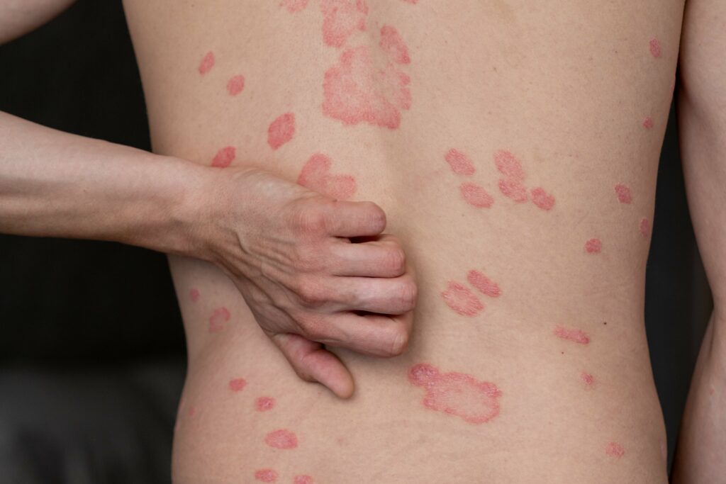 psoriasis  vulgaris  skin  patches  are  typically  red