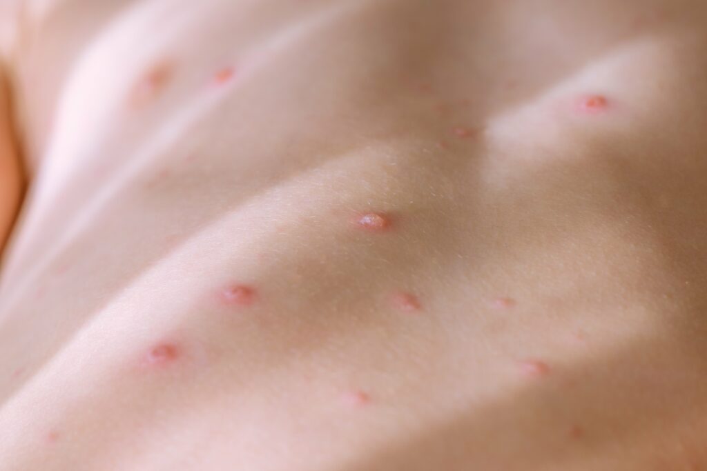chickenpox-blisters-on-body-of-child