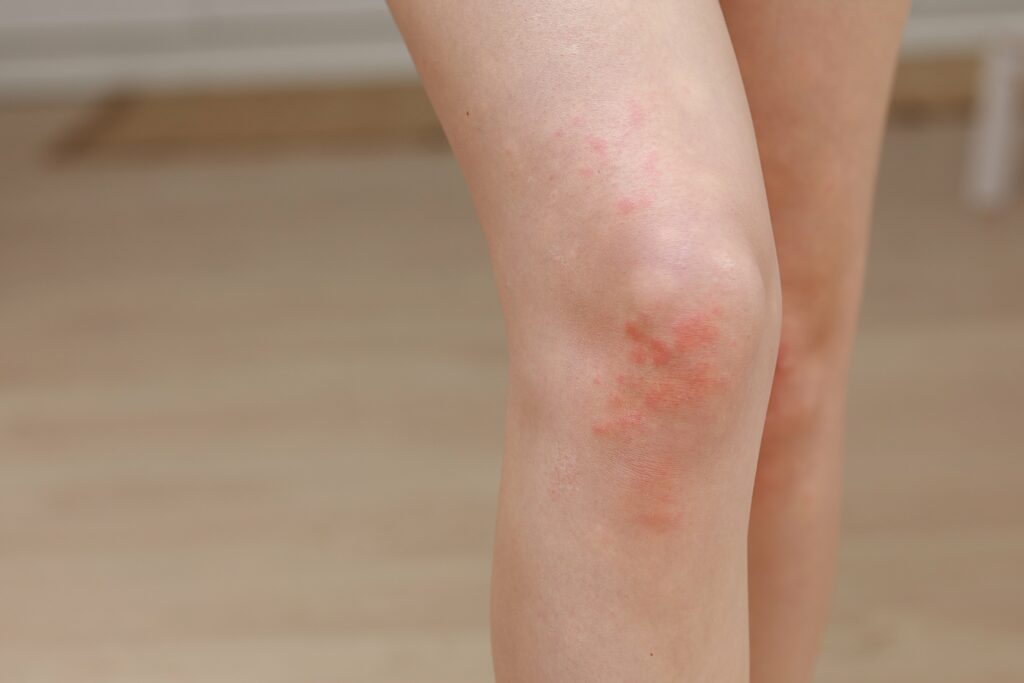 skin-allergies-legs-skin-women-closeup-of-red-pu-min